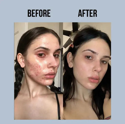 24H Acne Drying Lotion – Overnight Relief for Painful, Inflamed Pimples