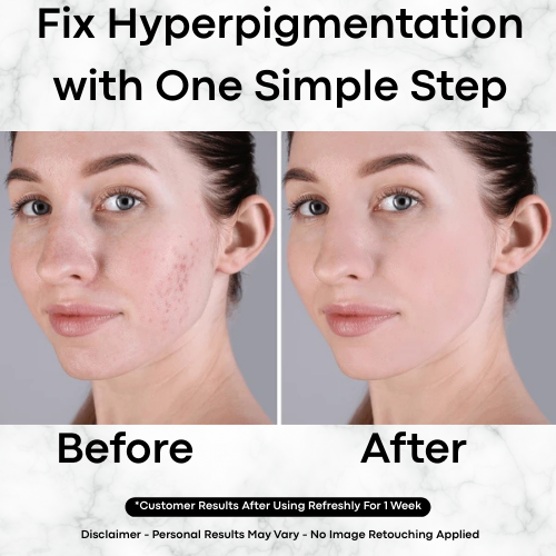 Korean Toner Pads for Dark Spots, Texture & Brighter Skin